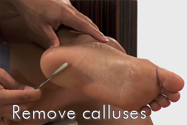 Remove calluses